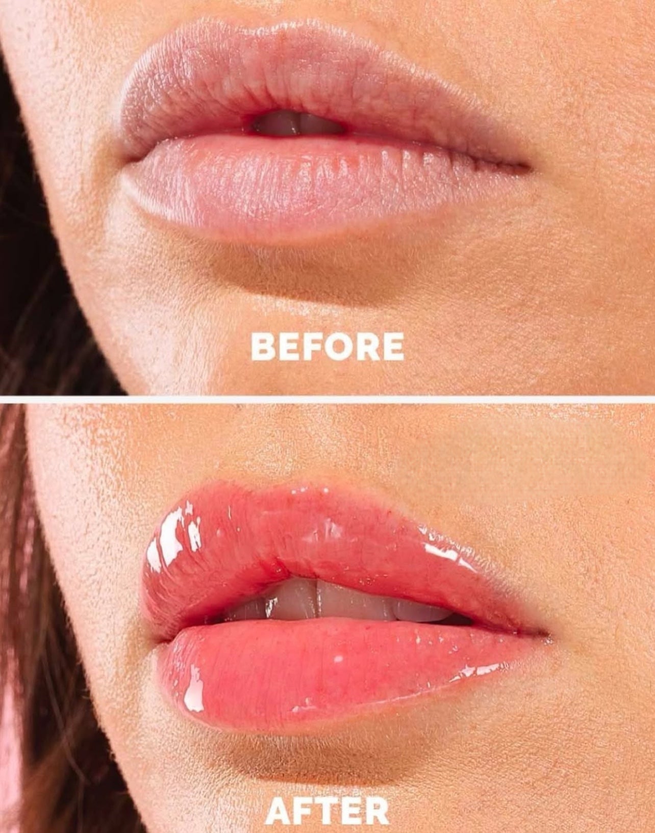 Lip filler